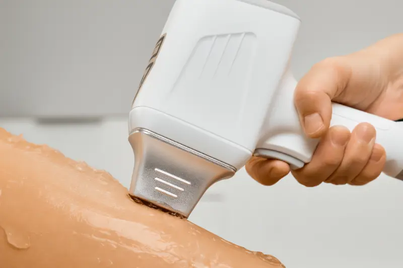 epilation laser 78